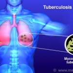 La tuberculosis es curable: ISSEA